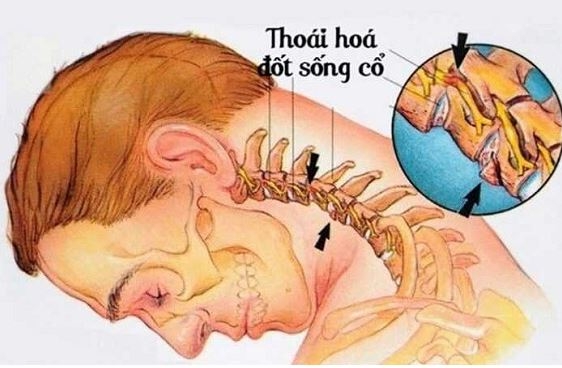 Thoái hóa đốt sống cổ là gì?